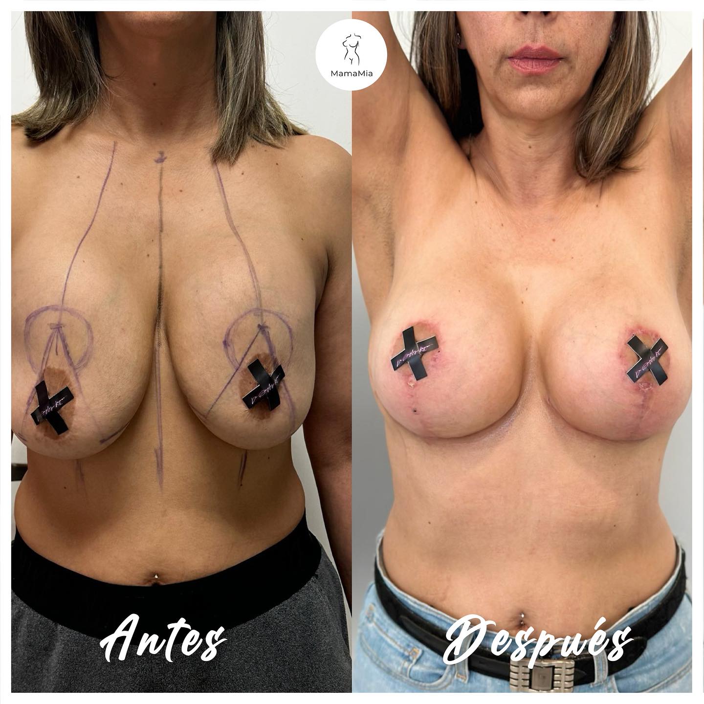 Mastopexia o levantamiento mamario