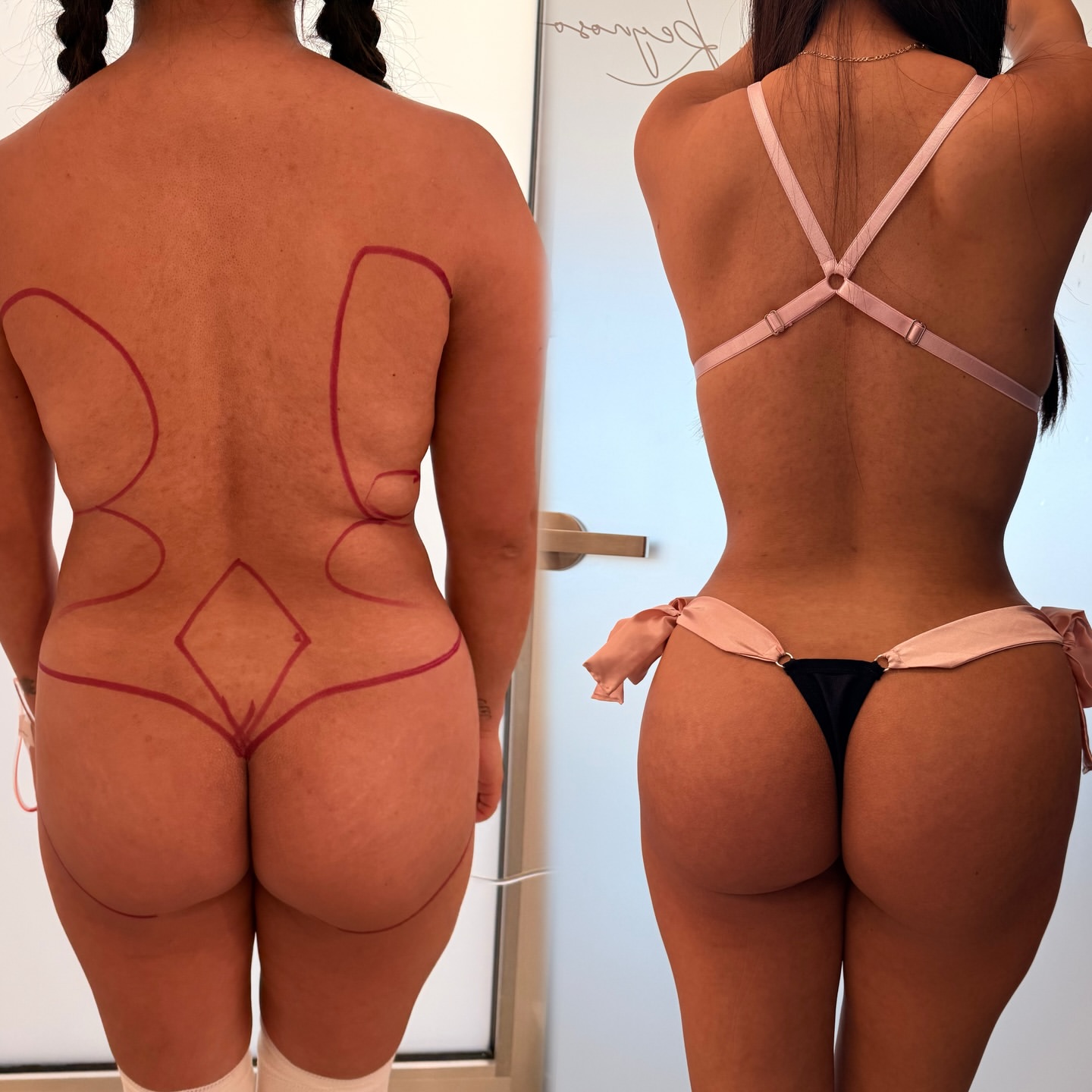 Lipoescultura